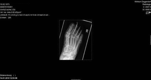 Behandlung von Krallenzehen